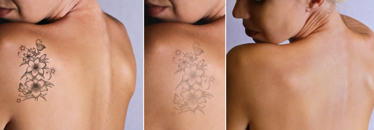 Laser Tattoo Removal Clinic in Mumbai | The Bombay Skin Clinic